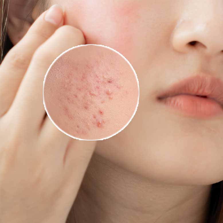 Puasa Bikin Jerawat Muncul? Cari Tahu Cara Merawat Kulit Agar Tetap Sehat