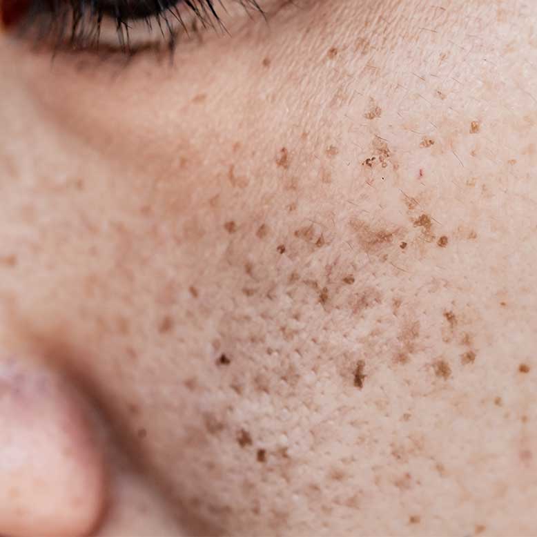 Dark Spot Hilang! Panduan Lengkap Atasi Noda Hitam di Wajah