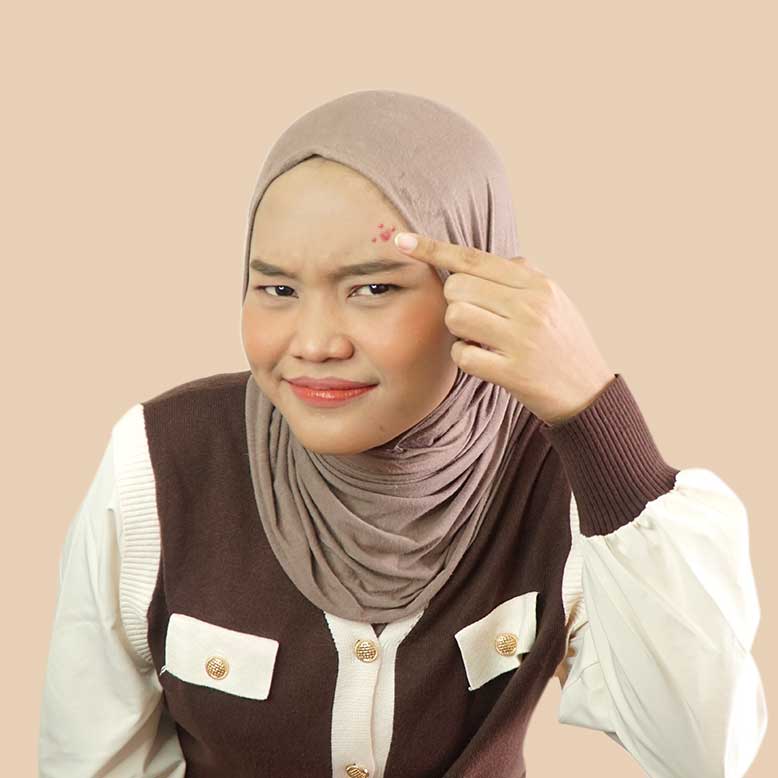 Jerawat Betah di Wajah Kamu? Ini Penyebabnya!
