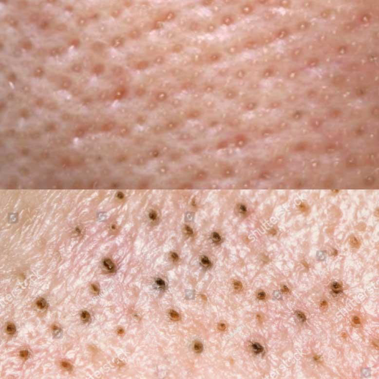 Whitehead vs Blackhead, Apa Bedanya &amp; Cara Mengatasinya
