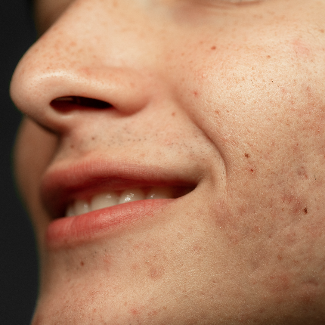 Bekas Jerawat Bikin Insecure? Stop Panik, Ini Solusinya